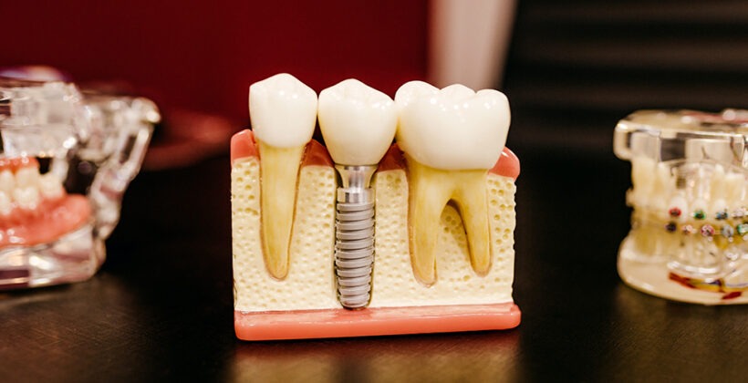 What are the Benefits of Dental Implants? | Phoenix Road Dental