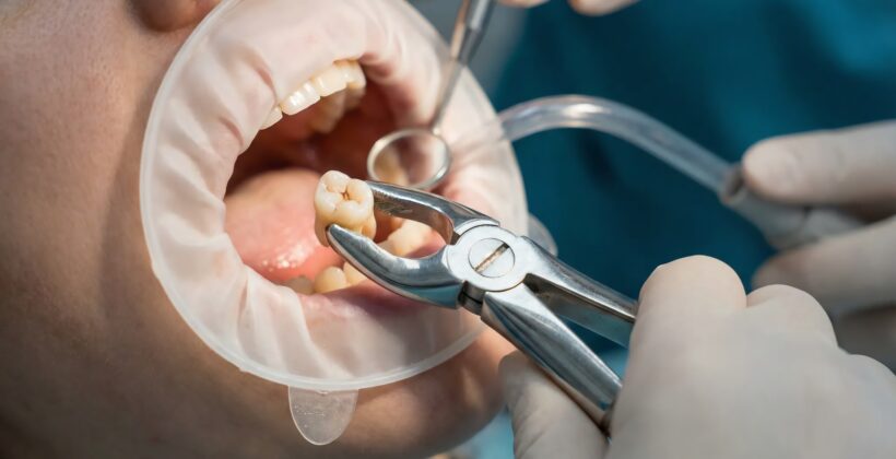 When Is a Tooth Extraction Necessary? Signs It May Be Time to Remove a Tooth When Is a Tooth Extraction Necessary? Signs It May Be Time to Remove a Tooth